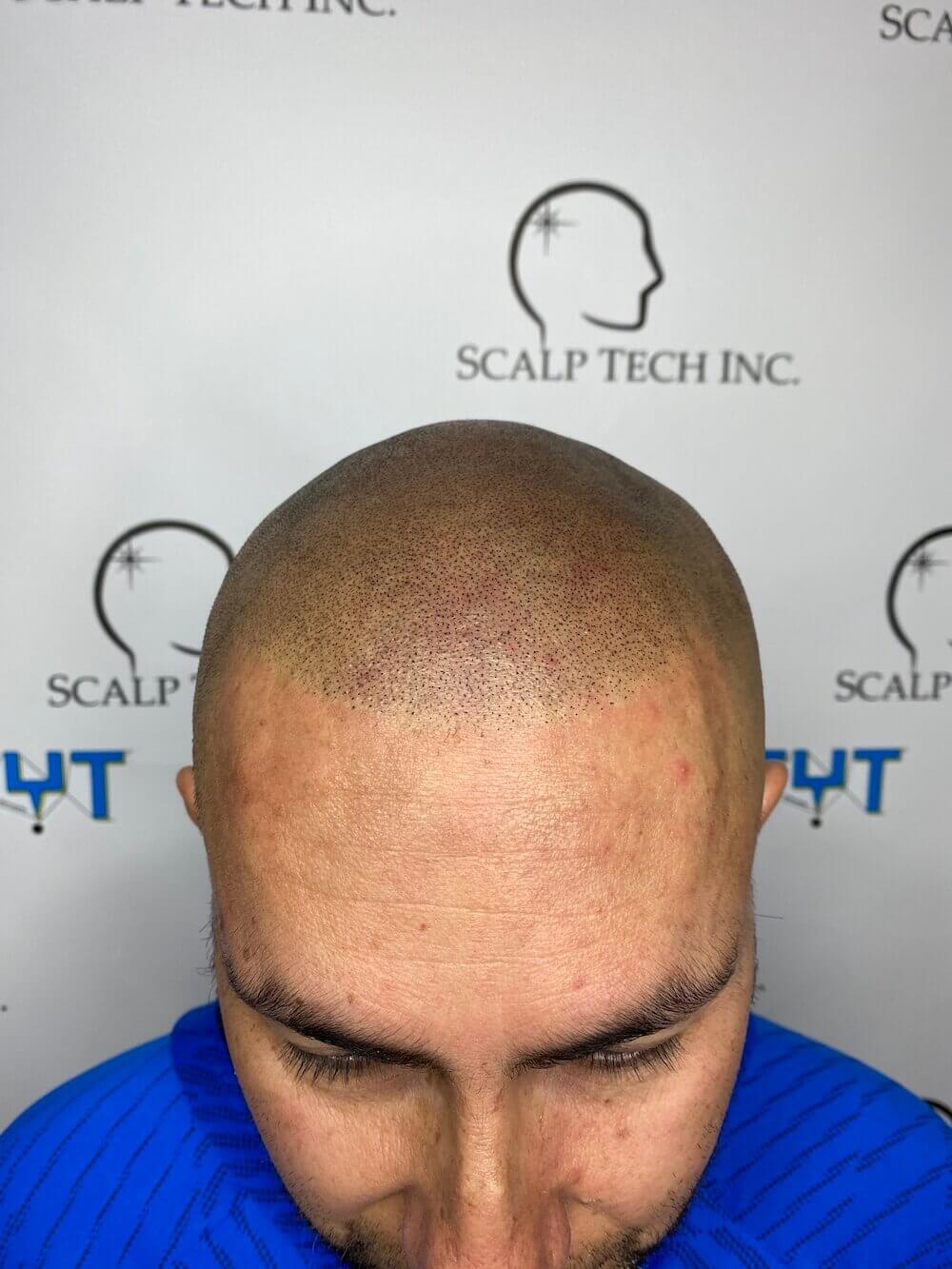 scalp micropigmentation | Scalp Tech Inc.