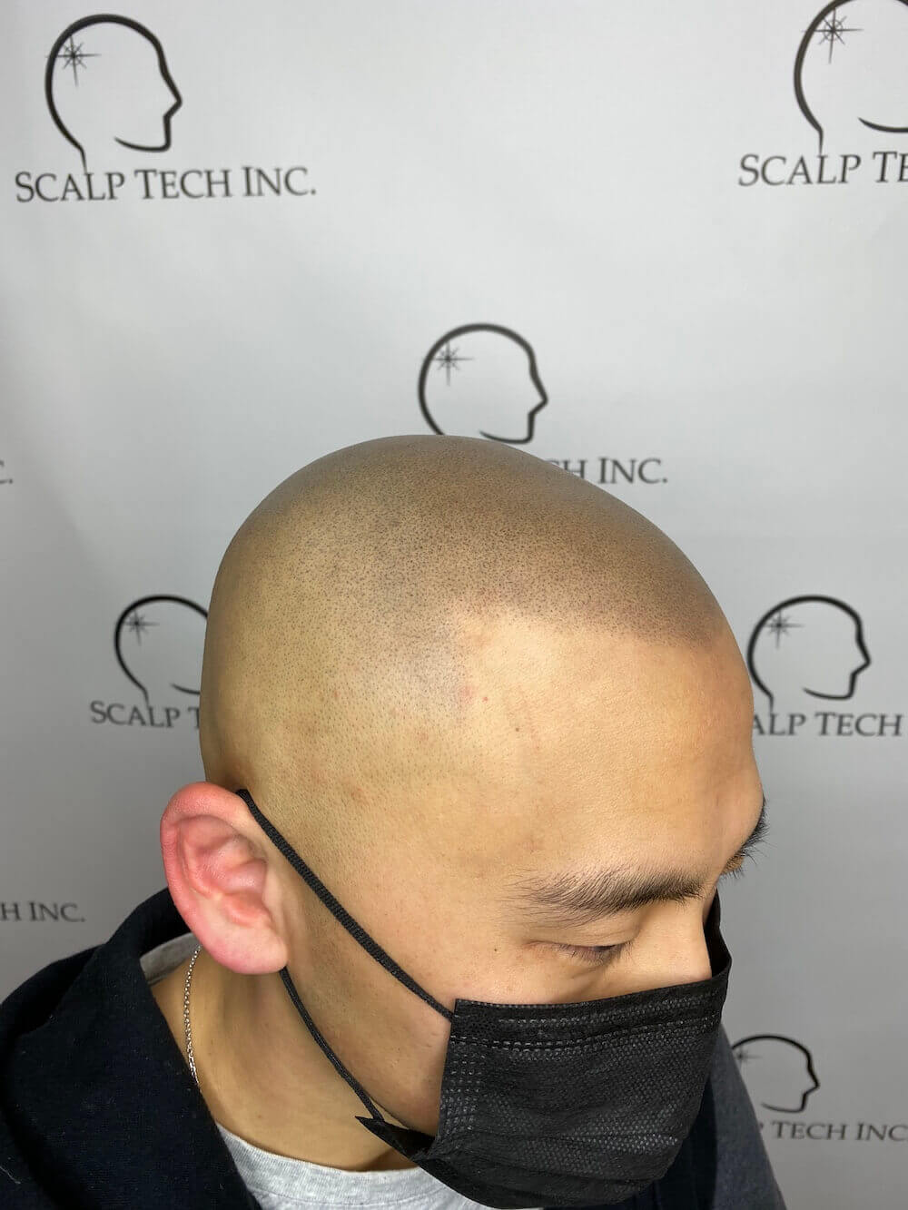 SMP | Scalp Tech Inc.