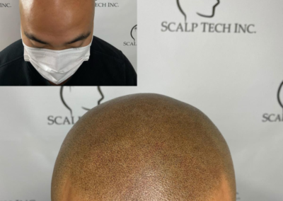 Terry Before & After Scalp Micropigmentation | Scalp Tech Inc.