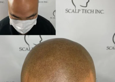 The Best Scalp Micropigmentation | Scalp Tech Inc.