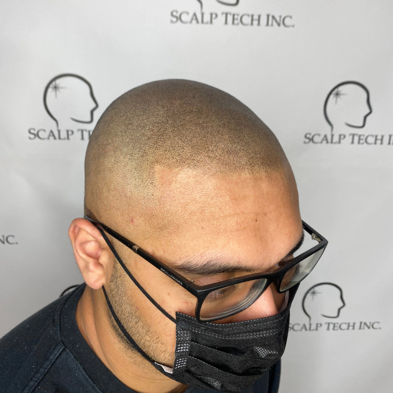 Carl After Scalp Micropigmentation | Scalp Tech Inc.