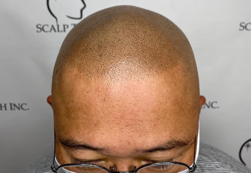 scalp micropigmentation | Scalp Tech Inc.