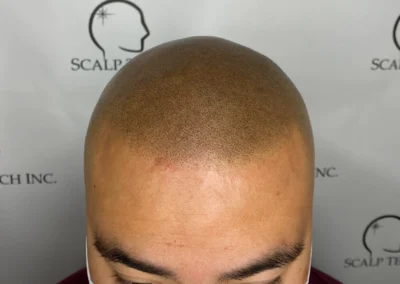 tight Scalp Micropigmentation | Scalp Tech Inc.