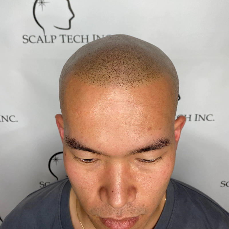 More After Scalp Micropigmentation (SMP) | Scalp Tech Inc.