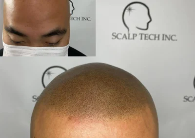 Scalp Tech Inc Scalp Micro-pigmentation | Scalp Tech Inc.
