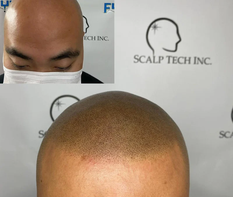 Understanding Scalp Micro-Pigmentation – SMP – for Hair Loss