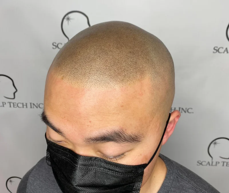 An Introduction to Scalp Micropigmentation: What to Know Before You Go