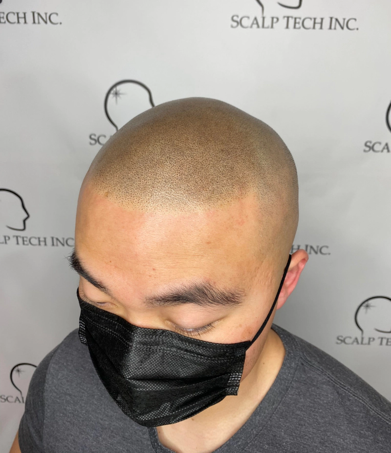 SMP finished Scalp Micropigmentation | Scalp Tech Inc.