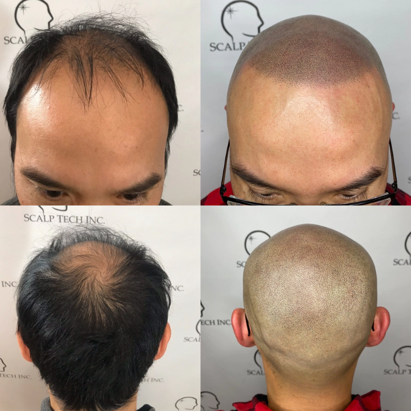 scalp micropigmentation | Scalp Tech Inc.