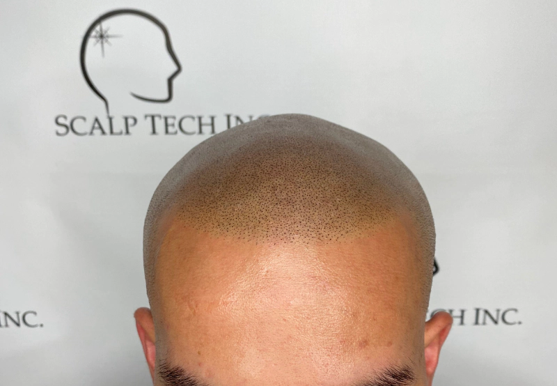 Mark After Scalp Micropigmentation | Scalp Tech Inc.