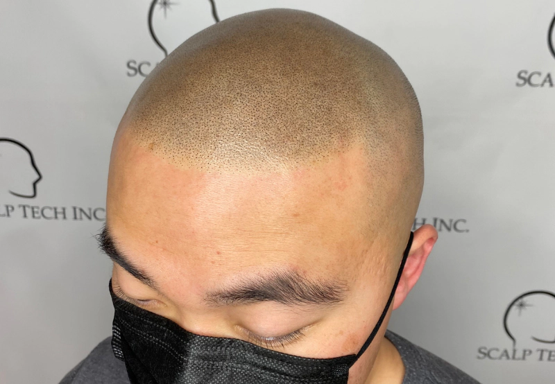 scalp micropigmentation | Scalp Tech Inc.